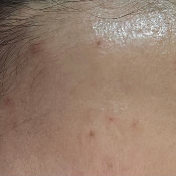 Ürünler Sivilce Sorununu Çözmedi, Aksine Artırdı