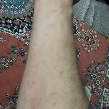 Alerjik Reaksiyon Ve Cilt Sorunları