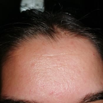 Tonik Etkili Temizleyici Yüzümde Sorun Yarattı