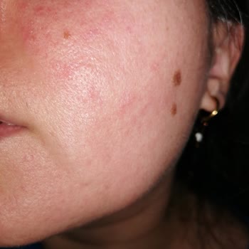 Tonik Etkili Temizleyici Yüzümde Sorun Yarattı