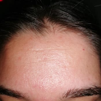 Tonik Etkili Temizleyici Yüzümde Sorun Yarattı