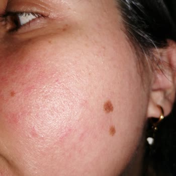 Tonik Etkili Temizleyici Yüzümde Sorun Yarattı