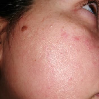 Tonik Etkili Temizleyici Yüzümde Sorun Yarattı