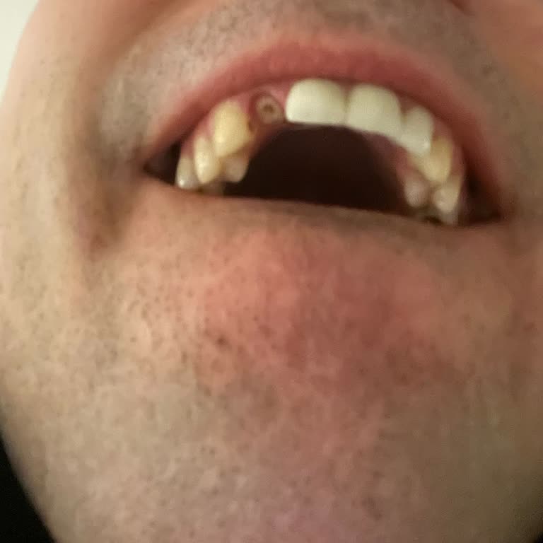 Dental Clinic Charged Me for an Implant but Gave Me a Faulty Crown Instead