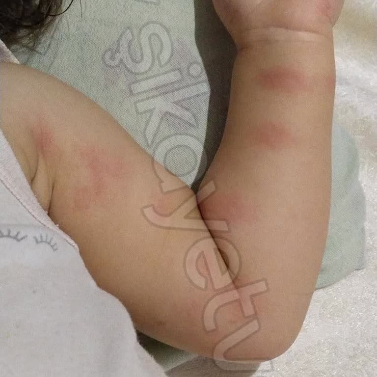 Antibiyotik Alerjisi: Kızarıklık Ve Tepkisizlik