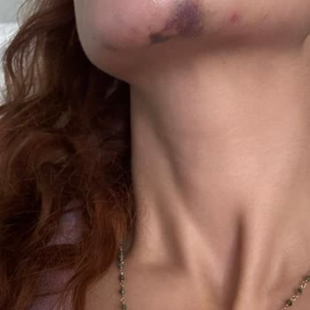 Clinimed Yanlış Çene Dolgusu ve Psikolojik Baskı