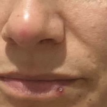 İcollagen Ürün Kullanımı Sonrası Sağlık Sorunları Ve Hayal Kırıklığı