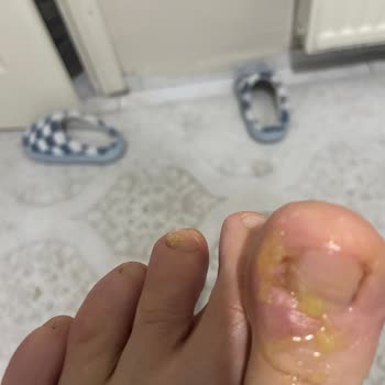 İcollagen Ürün Kullanımı Sonrası Sağlık Sorunları Ve Hayal Kırıklığı