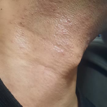 Philips Shaver 3000x Gave Me Severe Irritation and Refused My Refund Request