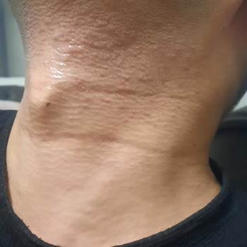 Philips Shaver 3000x Gave Me Severe Irritation and Refused My Refund Request