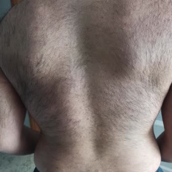 Epilasyon Fiyaskosu: Artan Tüyler Ve Bozulan Psikoloji