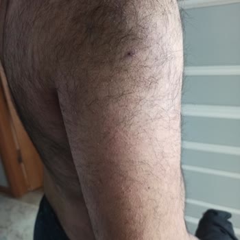 Epilasyon Fiyaskosu: Artan Tüyler Ve Bozulan Psikoloji