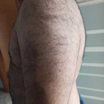 Epilasyon Fiyaskosu: Artan Tüyler Ve Bozulan Psikoloji