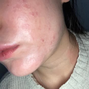 Bioderma Güneş Kremi Hassas Ciltlerde Soyulma Sorunu