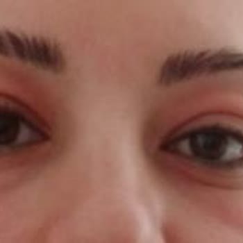 Cilt Kremi Kullanımı Sonrası Göz Şişmesi Ve Yanma Sorunu