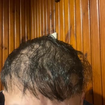 Saç Ekimi Kabusu: Beklentilerimin Altında Kalan Deneyim