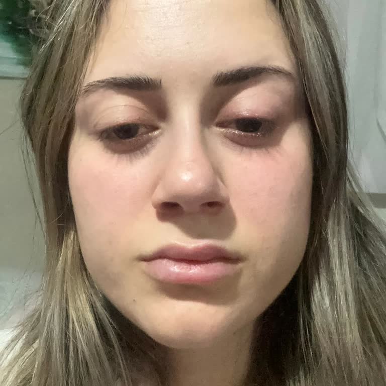 Anestezi Sonrası Göz Problemi