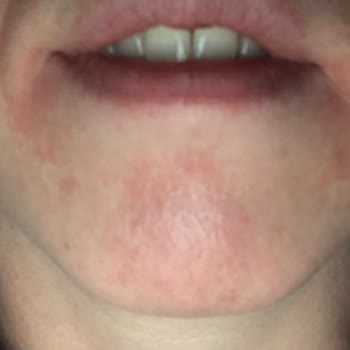 Maruderm Yeni Ambalaj Eski Kaliteyi Aratıyor