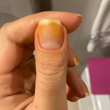 Flormar Oje Tırnaklarda Kalıcı Lekeler Bırakıyor