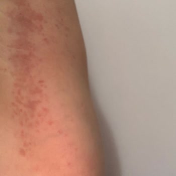 Rexona Deodorant İle Beklenmedik Alerjik Reaksiyon