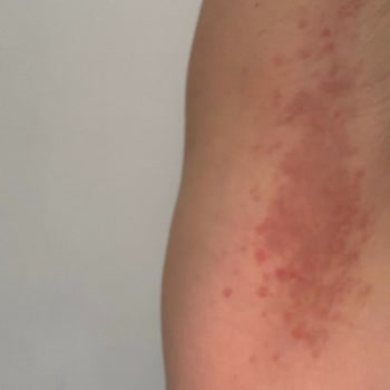 Rexona Deodorant İle Beklenmedik Alerjik Reaksiyon