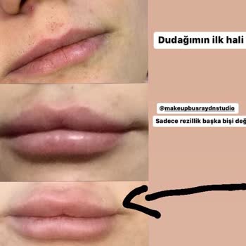 Büşra Aydın Makeup Beauty Center Başarısız Dudak Dolgusu İşlemi!