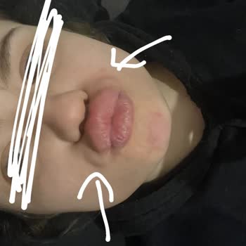 Büşra Aydın Makeup Beauty Center Başarısız Dudak Dolgusu İşlemi!