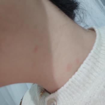 Trendyol'dan Aldığım Ürün Alerji Ve Yan Etkiler Yarattı