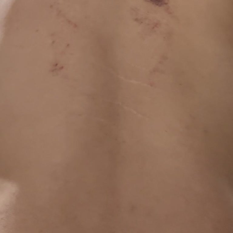 Masaj Mağduriyeti: Sırtımda Morluklarla Kaldım