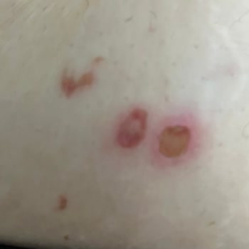 Bölgesel Zayıflama Seansında Yanık Problemi