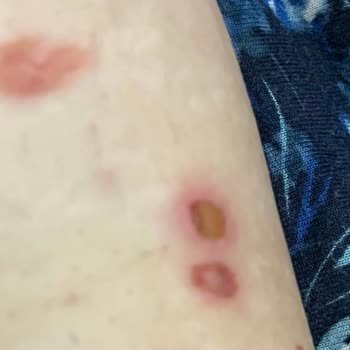 Bölgesel Zayıflama Seansında Yanık Problemi