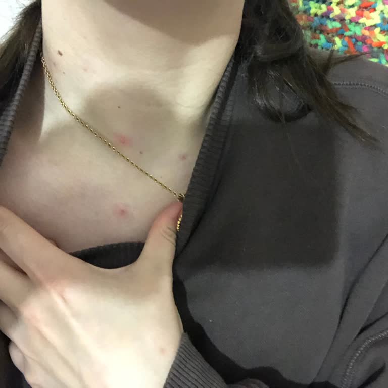 Restorex Şampuanı Kullanımı Sonrası Cilt Sorunları