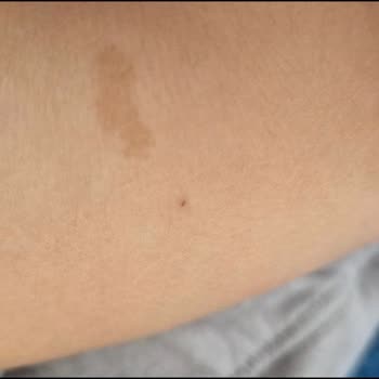 Yanlış Enjektör Ucu İle Bebeğime Yapılan İğne Şoku