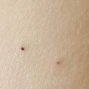 Yanlış Enjektör Ucu İle Bebeğime Yapılan İğne Şoku