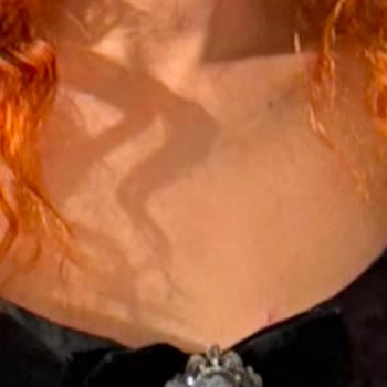 Clinimed Chin Filler Left Me with Asymmetry – Unnatural and Unethical Service