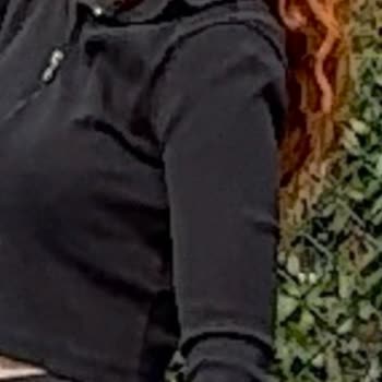 Clinimed Chin Filler Left Me with Asymmetry – Unnatural and Unethical Service