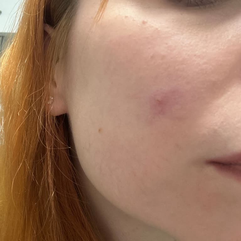 Kiperin Kolajeni Ciltte Ağrılı Sivilcelere Sebep Oluyor