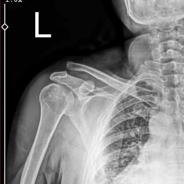 Tedavi Sürecinde İhmal: Kolumu Kullanamıyorum