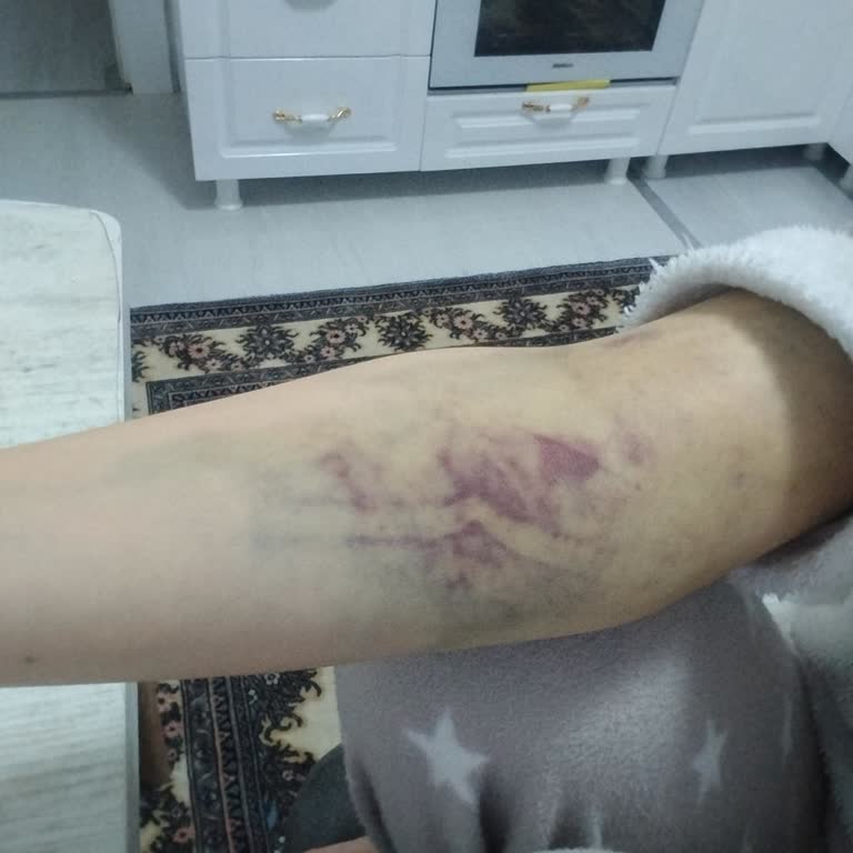 Türk Kızılay Kan Bağışı Sonrası Beklenmedik Ağrı Ve Morarma