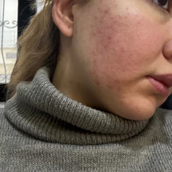 Nemlendirici Serum Yüzümü Yaktı, Acil Yardım Bekliyorum