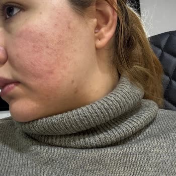 Nemlendirici Serum Yüzümü Yaktı, Acil Yardım Bekliyorum