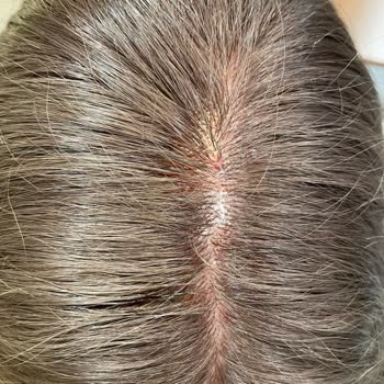 Kuaförde Yaşanan Saç Derisi Sorunları