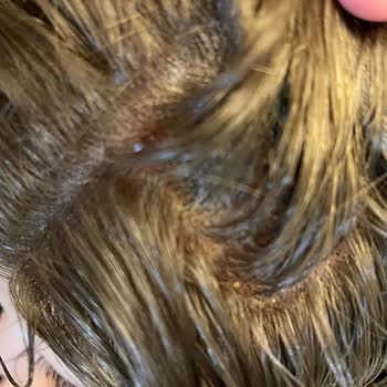 Kuaförde Yaşanan Saç Derisi Sorunları