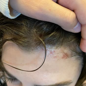 Kuaförde Yaşanan Saç Derisi Sorunları