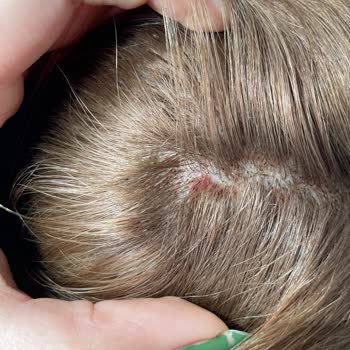 Kuaförde Yaşanan Saç Derisi Sorunları