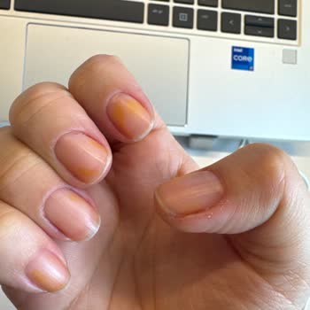 Flormar Oje Sonrası Kalıcı Lekelerle Karşılaştım