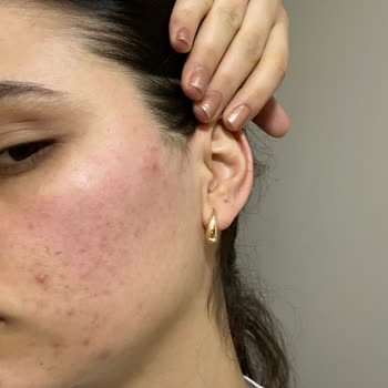 Bioderma Hydrabio Jel Krem Ciltte Tahrişe Sebep Oldu