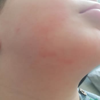 Creme Ultra Serisi Cilt Problemleri Yarattı