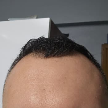 Leke Karşıtı Krem Cildimi Tahriş Etti