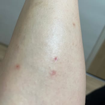 Glycolic Asit Kullanımı Sonrası Cilt Sorunları